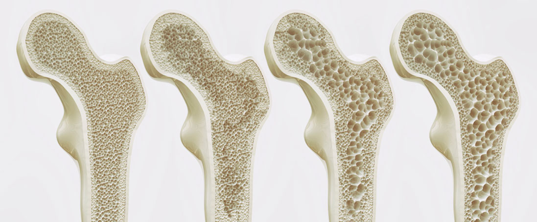 остеопороз костей при недостатке кальция